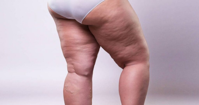 LIPEDEMA_O_QUE_É